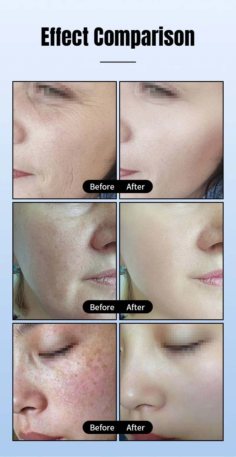 2024 IPL Opt Shr Permanent Hair Removal Skin Rejuvenation Machine