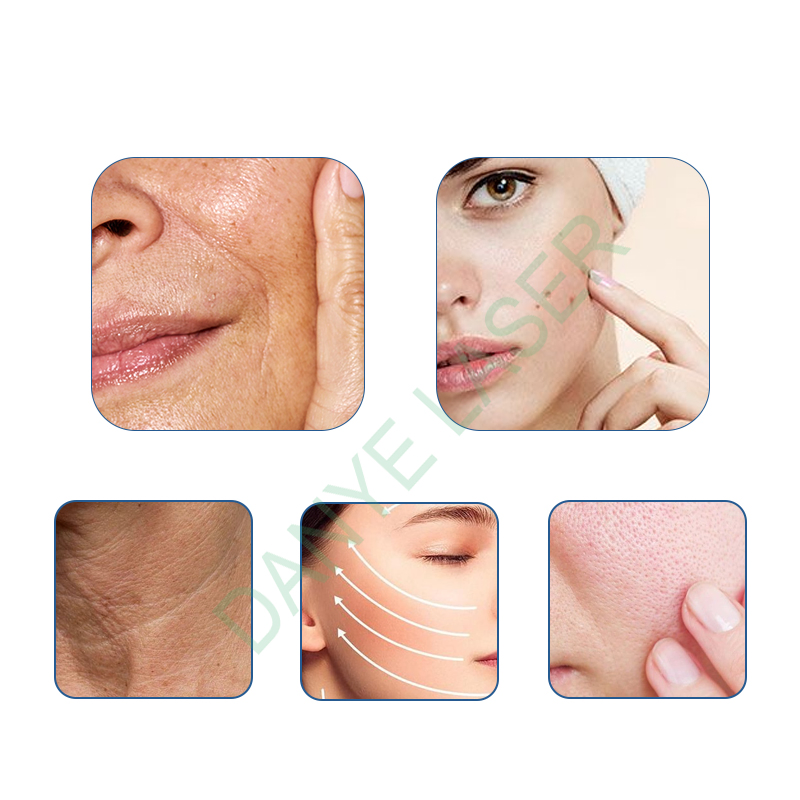 Microneedling Fractional RF Machine Face Treatment Device for Skin Tightening and Rejuvenation