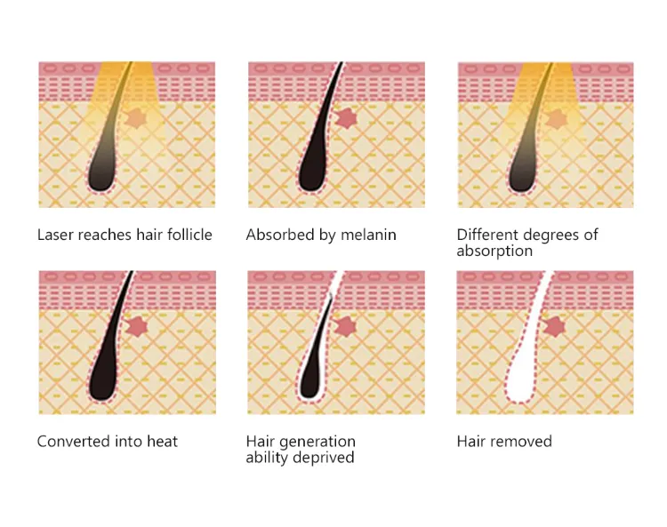 Laser Hair Removal Principle