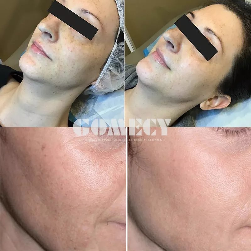 2023 New Dpl+Pico Laser 2 in 1 Machine Double System for Hair Removal Tattoo Removal Machine