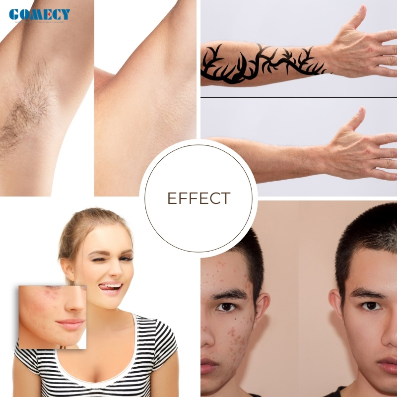 Pico Laser System for Removing Tattoos Age Spots Sun Damage and Enhancing Complexion Evenness