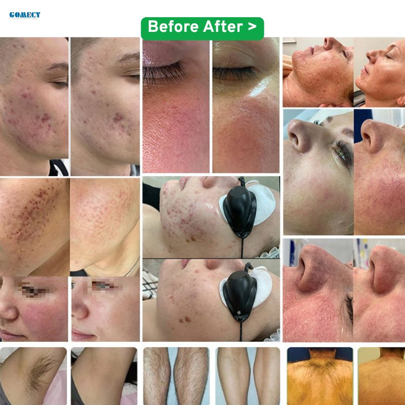 Portable M22 Skin Rejuvenation Beauty System with Hair Removal Tattoo Removal Function