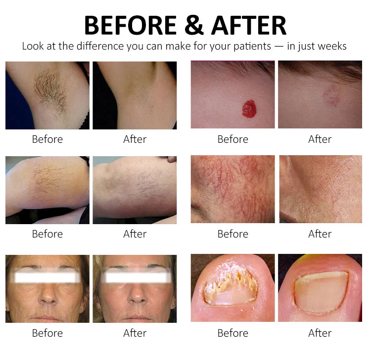 Laser Feature Showcase