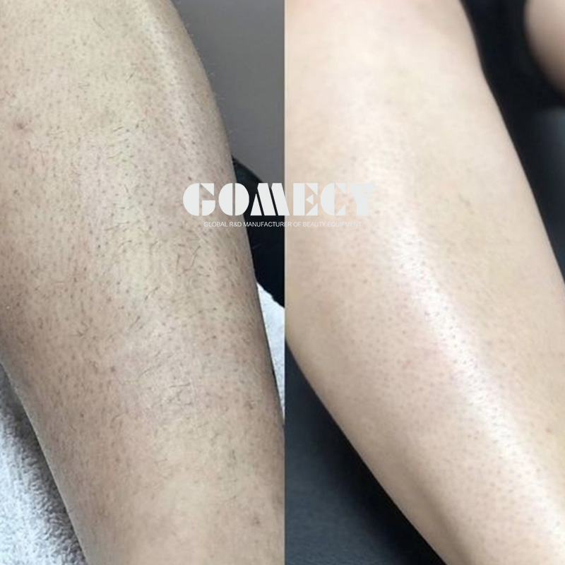 Ice Portable Laser Hair Remover 2025 755 808 1064nm Triple Wavelengths Diode Laser Hair Removal Machine