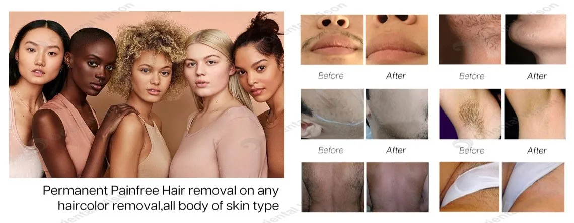 Before and After Results