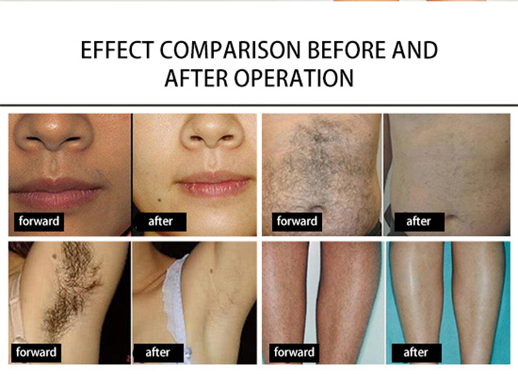 3 Waves Professional Portable Diode Ice Titanium Laser Body Hair Removal Machine 808nm Device for Woman's