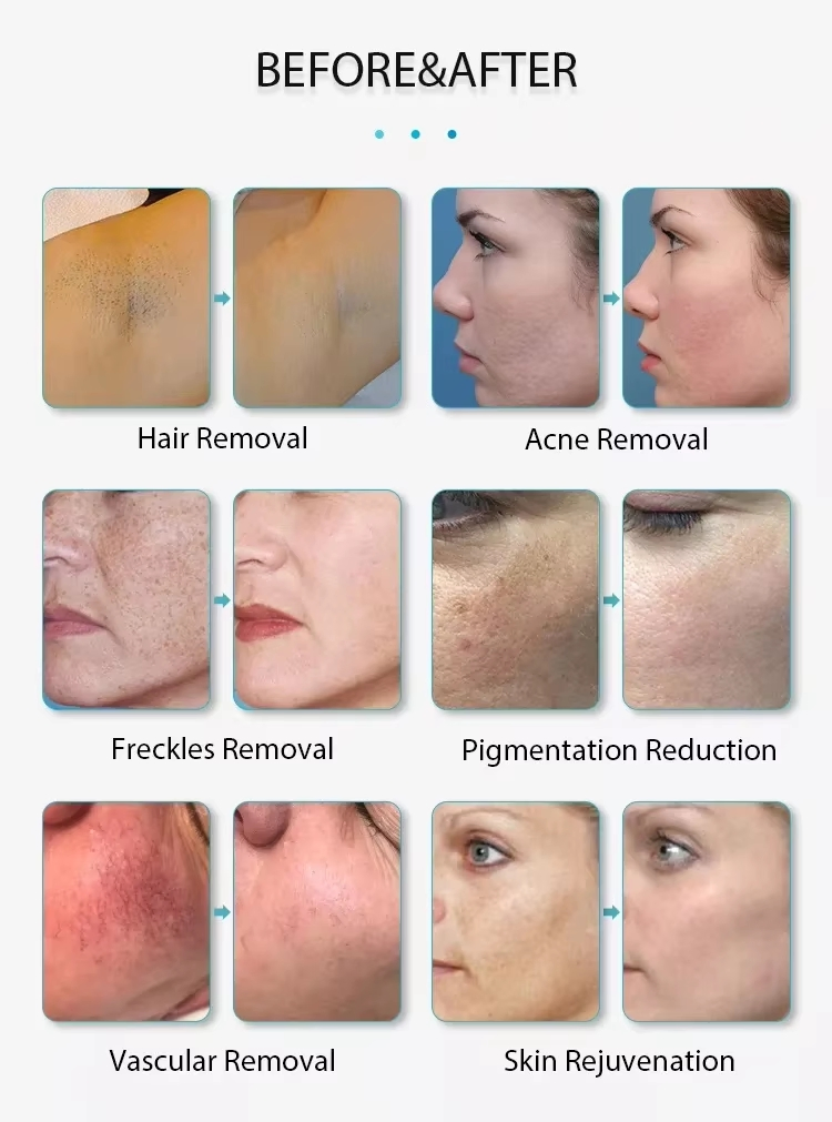 IPL Laser Therapy Hair Removal Skin Rejuvenation Blacken PRO Dpl Photofacial Skincare Device