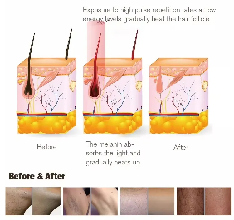 DPL Treatment Features