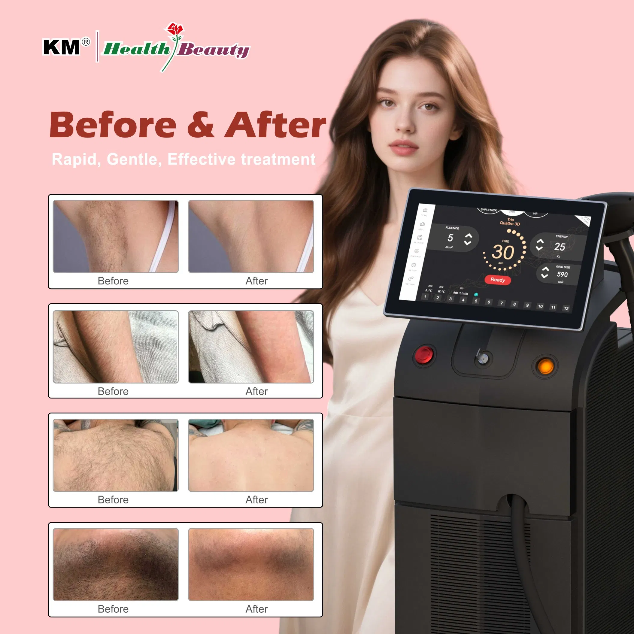 Km 808nm Diode Laser 755 808 1064nm Triple Wavelength Hair Removal for Fitzpatrick Skin Types I-VI