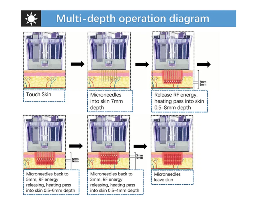 Microneedle RF System 4