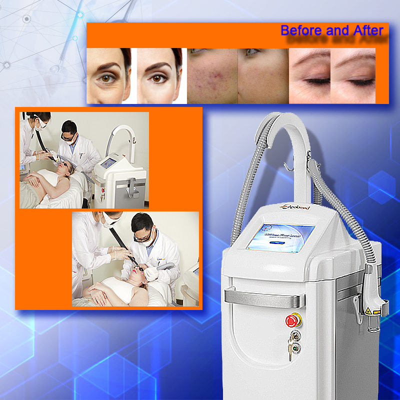 Acne Treatment Pigmentation Correctors 1550nm Erbium Glass Fractional Laser Equipment