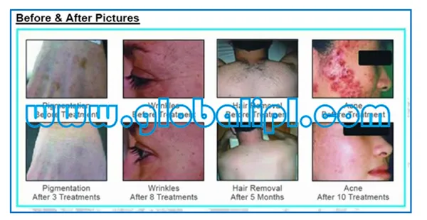 IPL Treatment Device