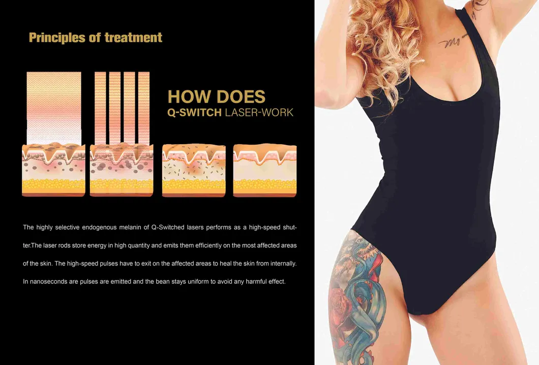 Tattoo Removal Process