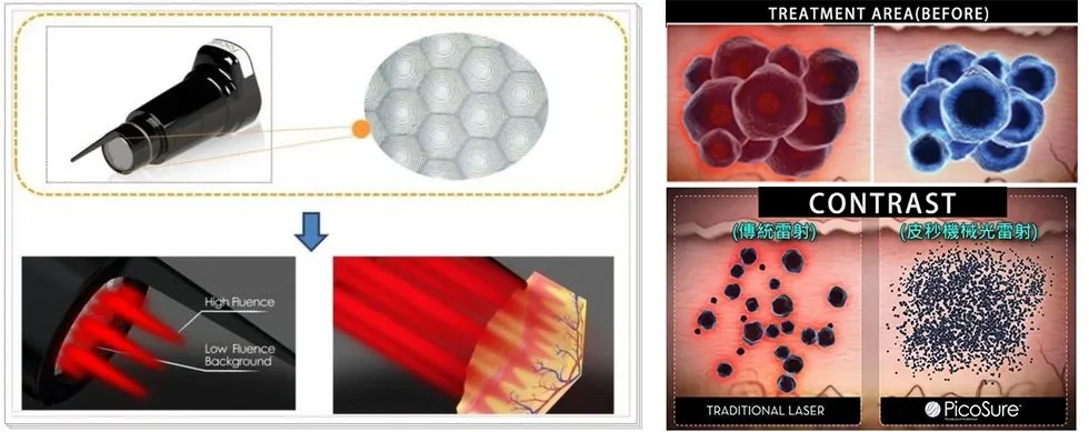 Picosecond Laser Overview