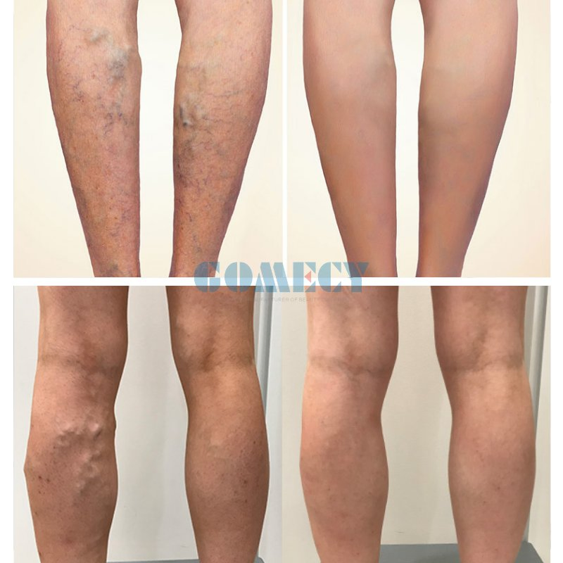 Multi Wavelength Laser System for Pain Relief and Skin Rejuvenation Treatment