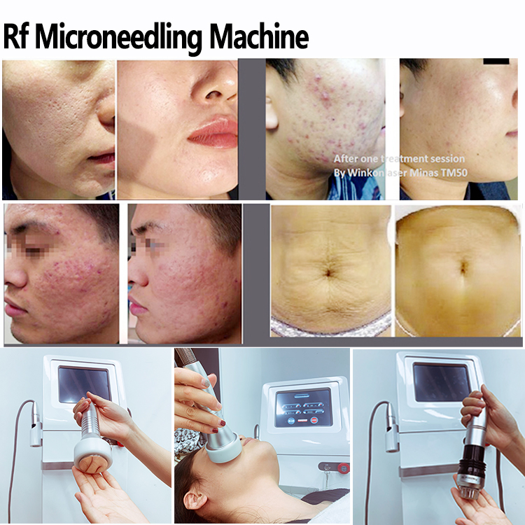 Fractional RF Microneedle Face Lift Rejuvenation Device
