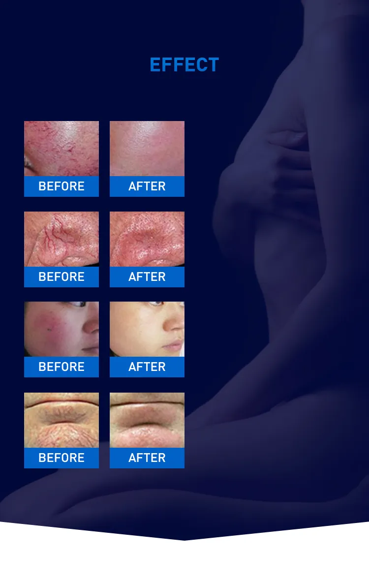 Vascular Removal Result