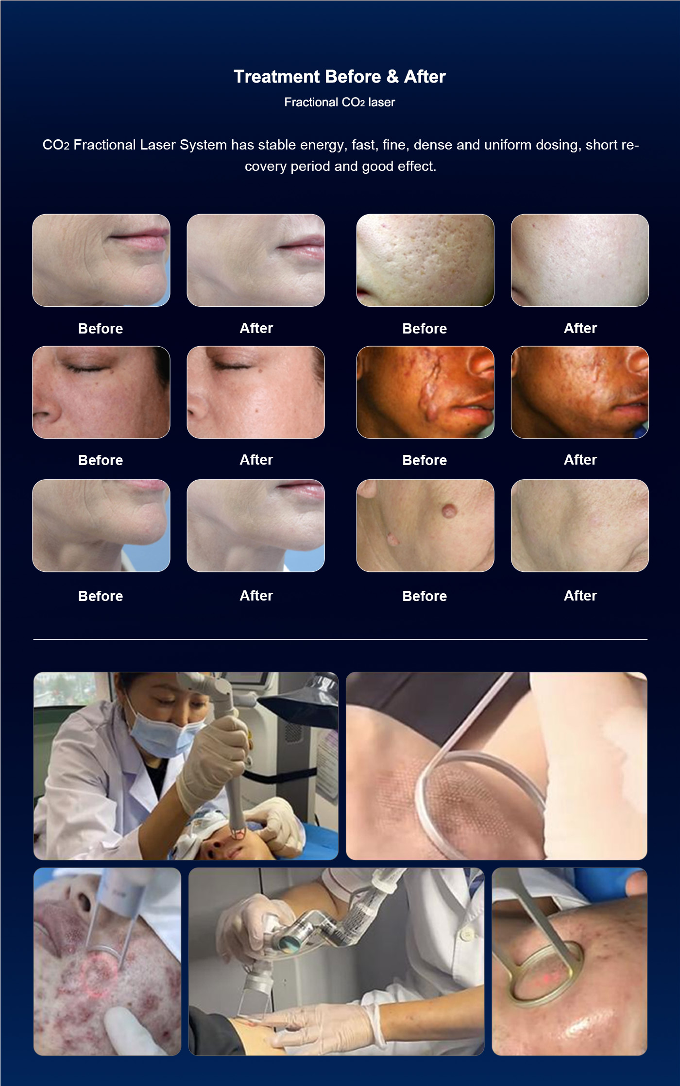 Portable Desktop CO2 Fractional Laser Machine 10600nm Vaginal Tightening Salon Aesthetic Apparatus Beauty Equipment
