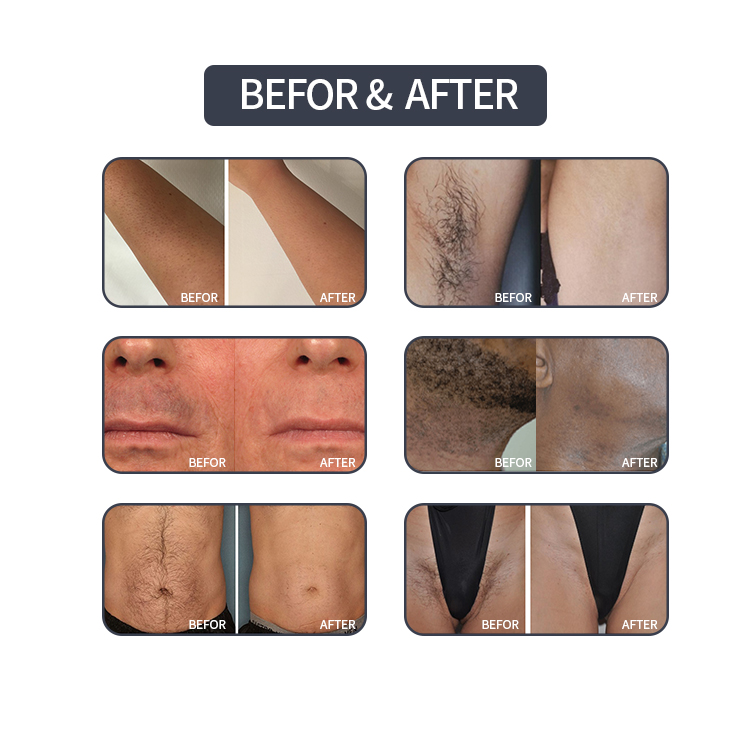 Laser hair removal advantage 4