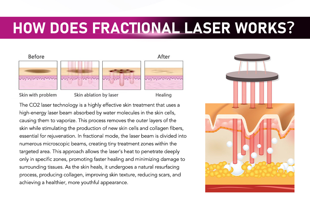 CO2 Fractional Laser Working Theory Diagram
