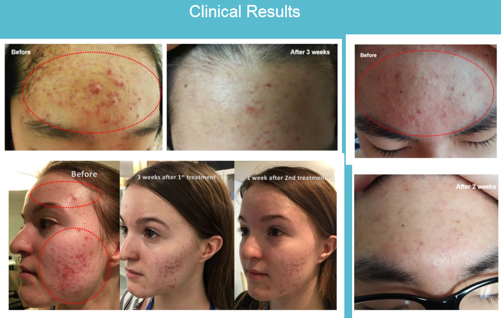 Before and After Treatment 1