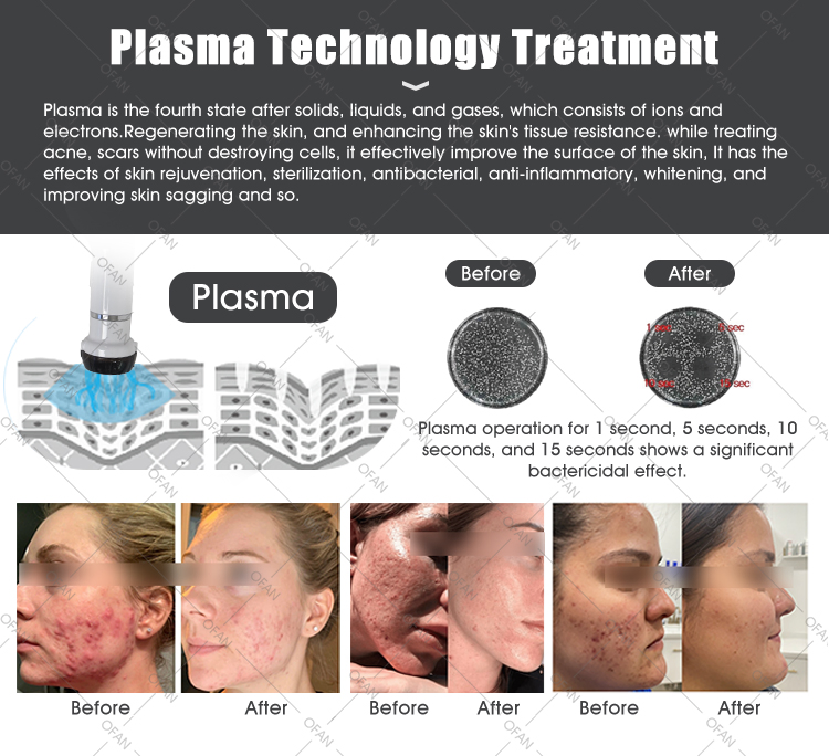 Ofan Plasma Pen Skin Rejuvenation Ance Treatment Freckle Removal Face Lifting Skin Tightening Beauty Machine