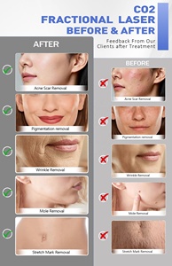 Fractional CO2 Laser Machine Radio Frequency Skin Tightening Resurfacing Rejuvenation Equipment for Clinics Profitable Products