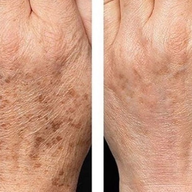 Before and after case 4