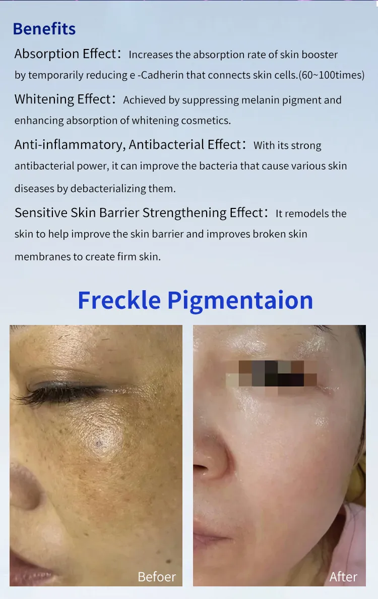 Cold Plasma for Spot Removal Skin Tightening Plasma Treatment Machine Face Lift Plasma Machine