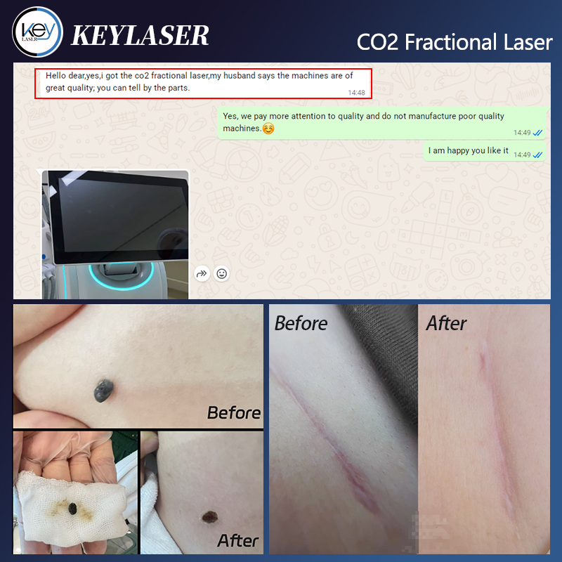 USA Hot Selling 510k Approved CO2 Fractional Laser 10600nm Co2 Fractional Laser Machine for Skin Scar Removal