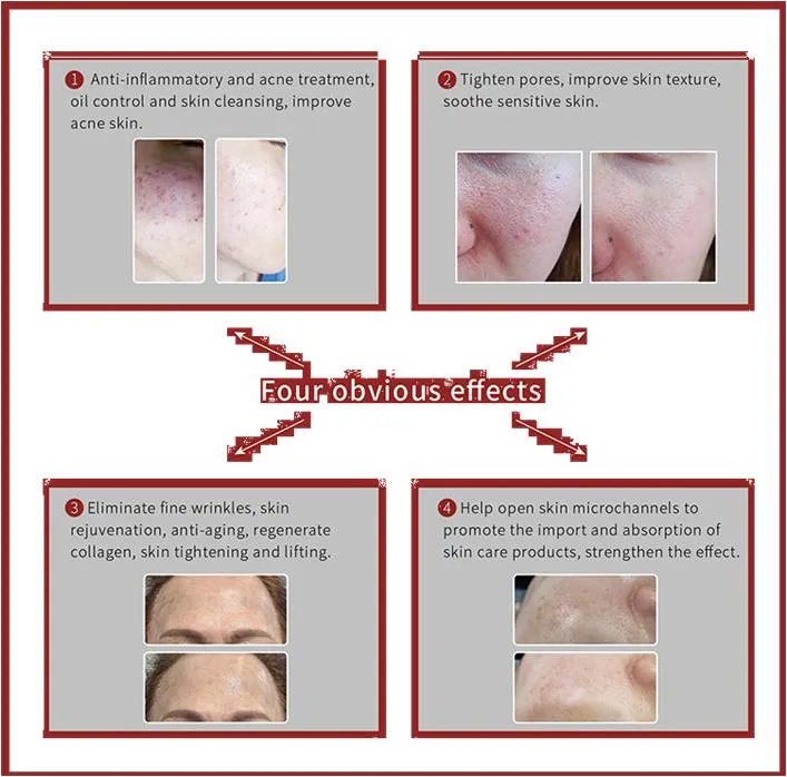 Skin Tightening Anti-Aging Double Handles Plasma Lifting Therapy Cold Plasma Cutting Mole Removal Plasma Beauty Machine