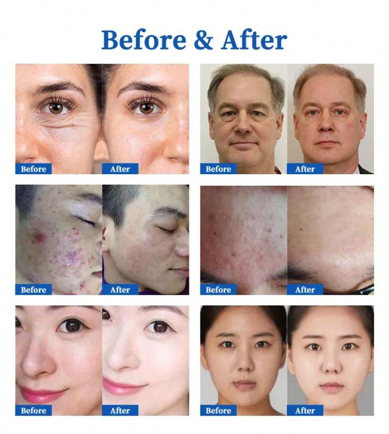 3 in 1 EMS Plasma Jet and Microneedling RF Cold Machine Beauty Glasses Fat Melting Skin Rejuvenation Tightening
