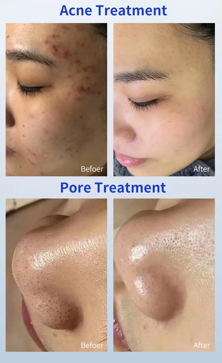 Cold Plasma Beauty Machine for Home Use Skin Tightening Facial Device Equipment
