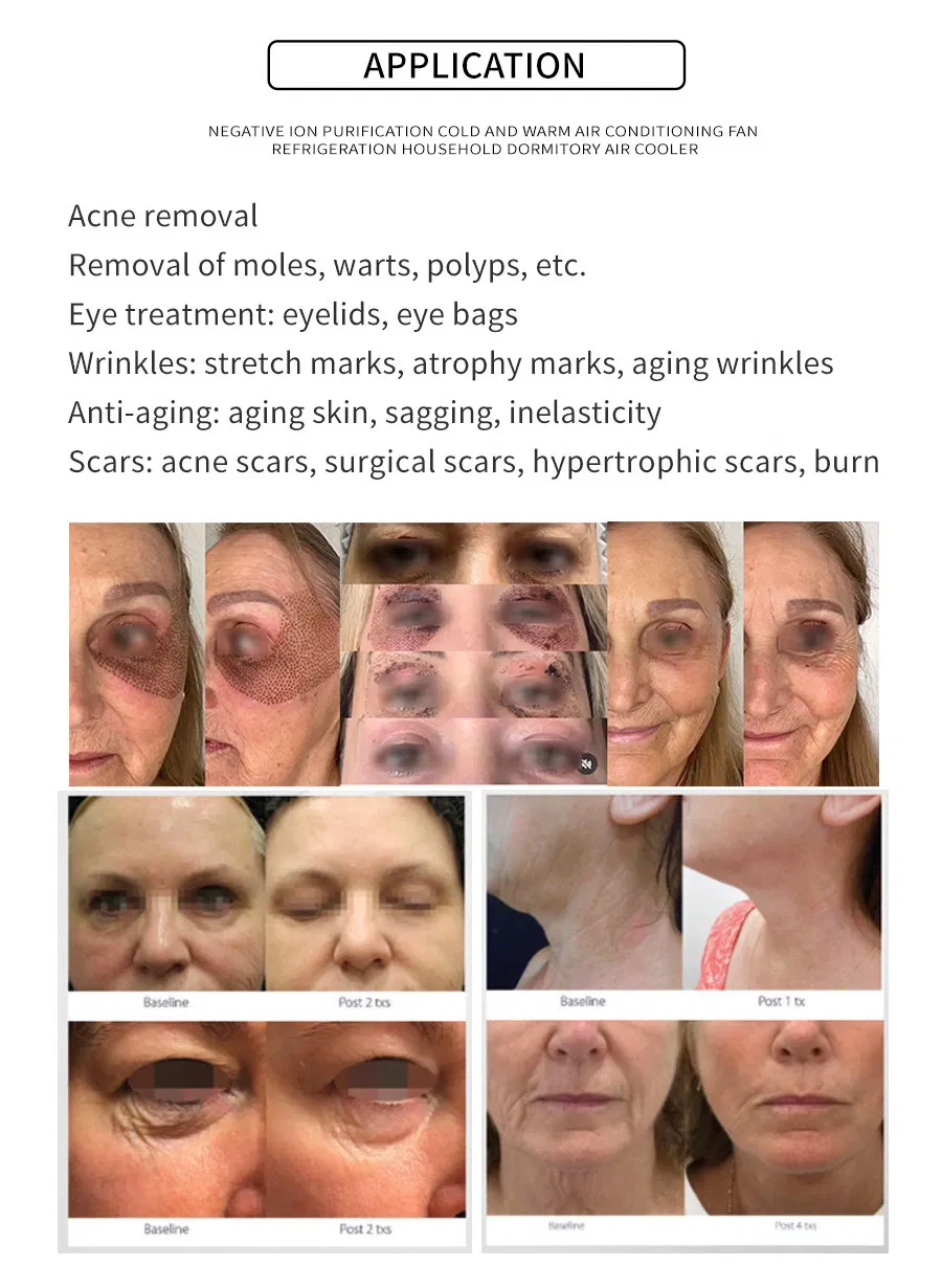 Skin Treatment Machine Scalp Care Jet Plasma Wrinkle Removal Skin Tightening Machine
