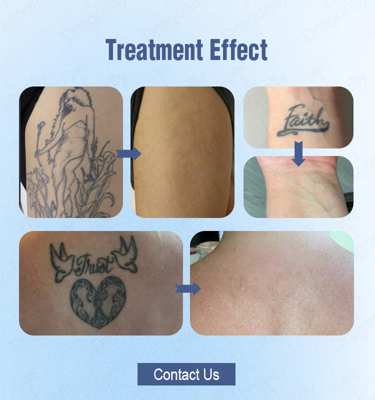 Tattoo Removal