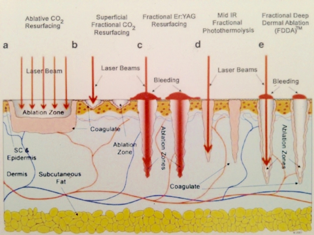 Picosecond Laser 3