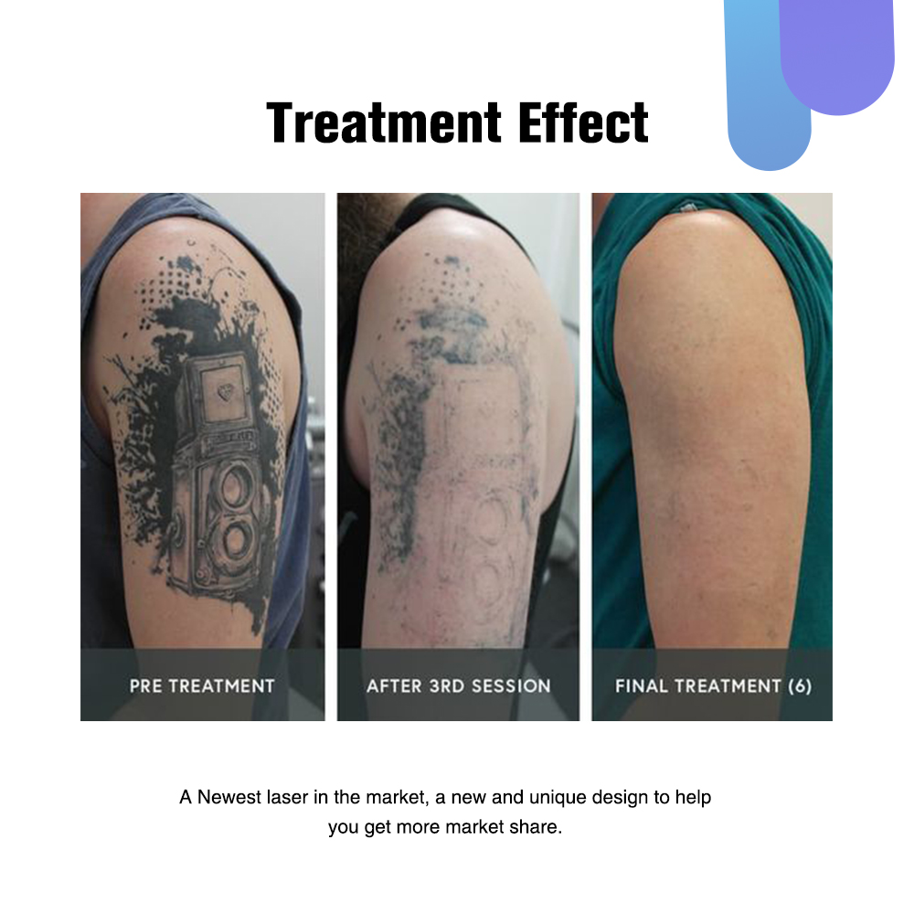 CE Certification Q Switch ND YAG Laser Permanent Tattoo Removal and Eyebrow Laser Tattoo Removal Machine Suppliers, Product