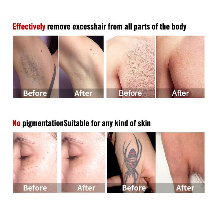 OEM Picolaser Picosecond Laser Portable Tattoo Removal Laser Machine Diode Laser Hair Removal Freckle Pigment Removal Quotes, Products