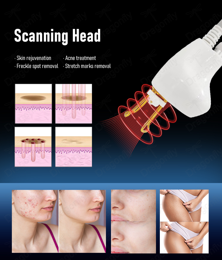 Vaginal Tightening Laser