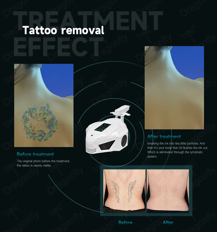 Tattoo Removal Tech