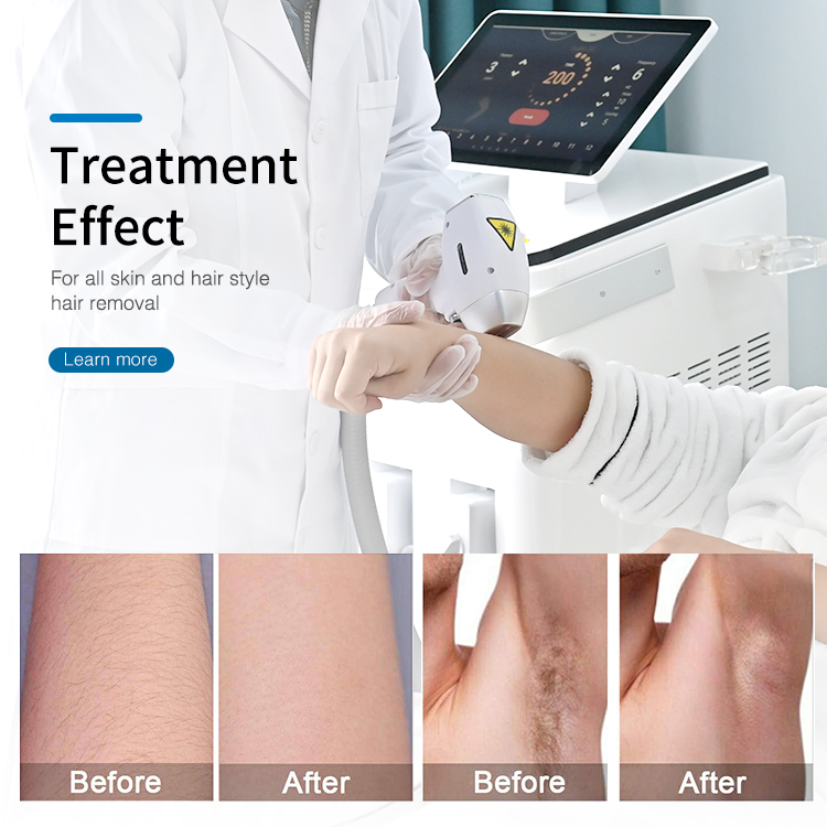 CE Certification 2025 New 808nm nd yag diode laser tattoo removal Ice titanium 755 808 1064 nm Diode Laser Hair Removal machine Suppliers, Quotes