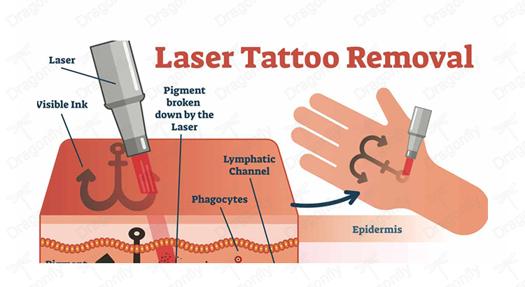 Laser Details