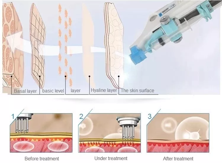 Mesogun 2