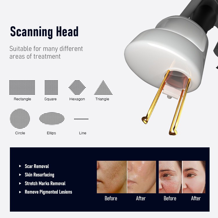OEM Co2 Fractional Laser Vaginal Tightening Machine Skin Treatment 980nm Diode Laser Vascular Removal Machine Factory, Products
