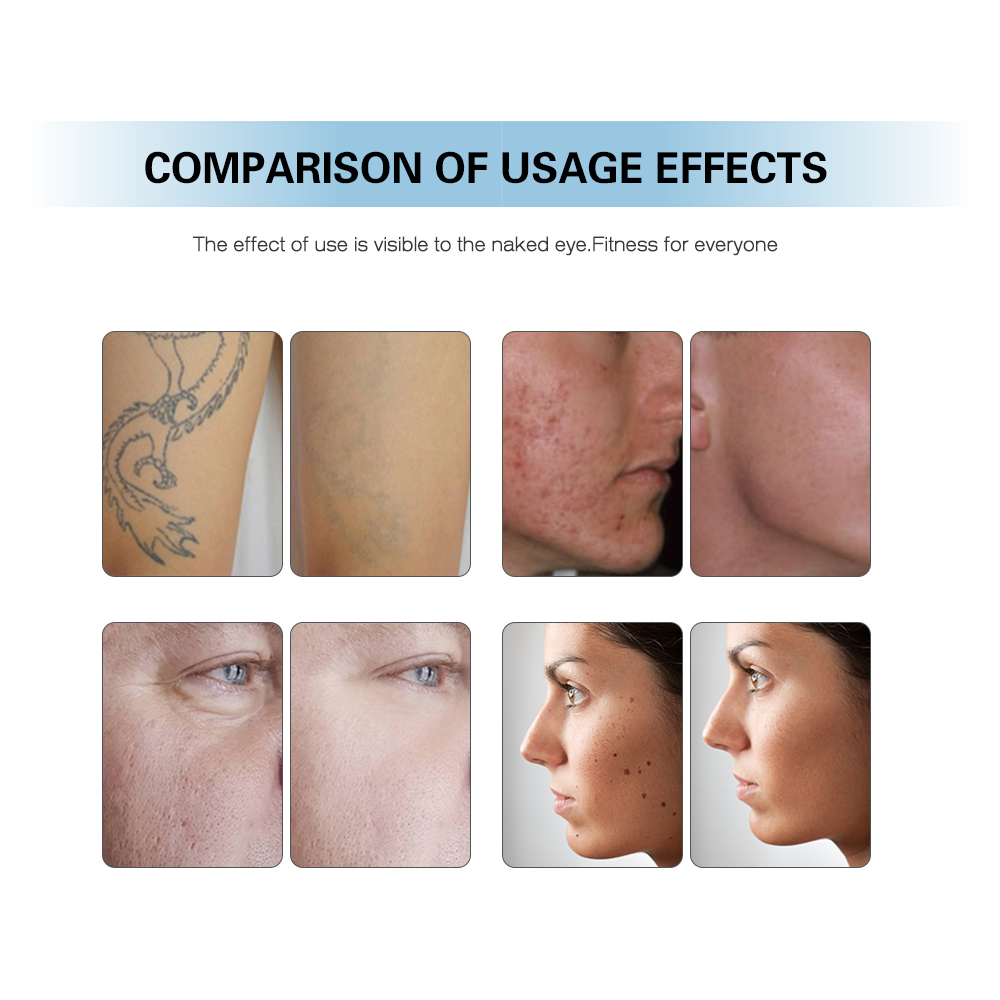 CE Certification DFLASER Medical CE 13485 TUV Approved Powerful Picosecond Nd Yag Melasma Laser Tattoo Removal Beauty Equipment Pricelist, Products