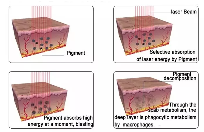 Picosecond Laser 2