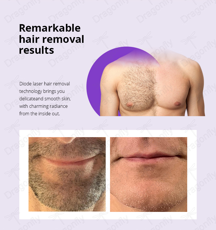 Laser hair removal 2