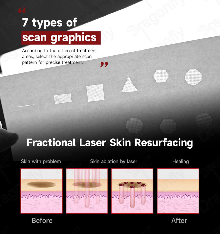 Skin Resurfacing