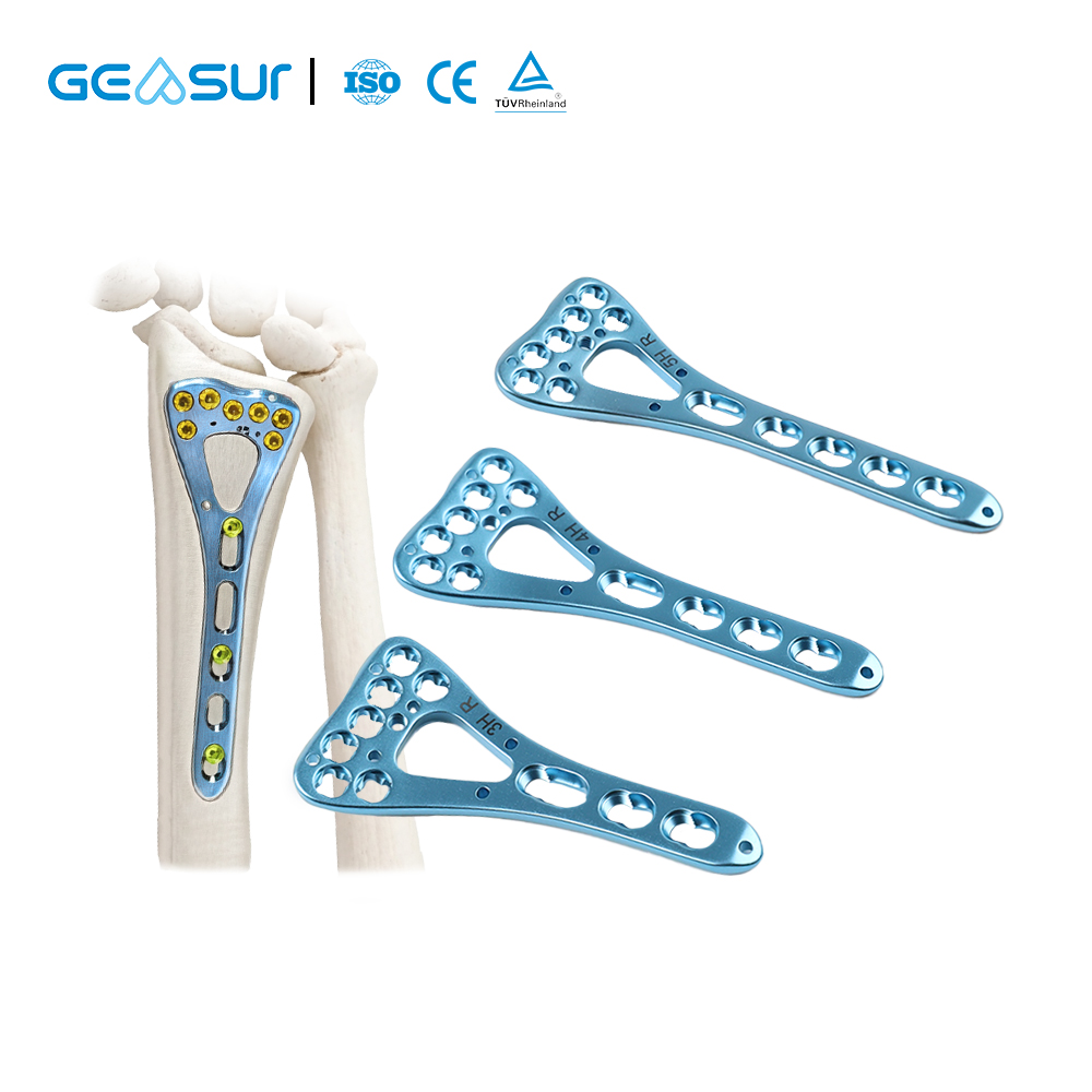 Variable-Angle Distal Radius Locking Plate for Orthopedic Trauma