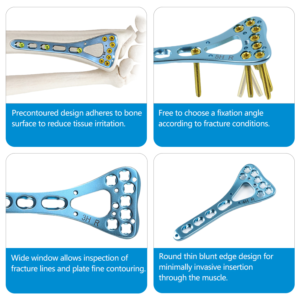 Distal Radius Medial Locking Plate for Orthopedic Trauma Implant, with Polyaxial Screw Holes for  Fracture Fixation.